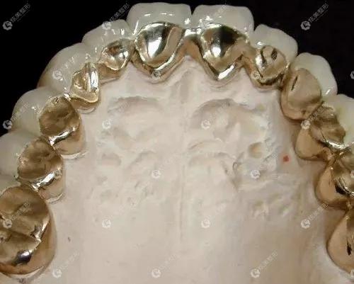 先说纯钛金属牙齿价格表是多少,再看纯钛和全瓷牙冠哪个更耐用