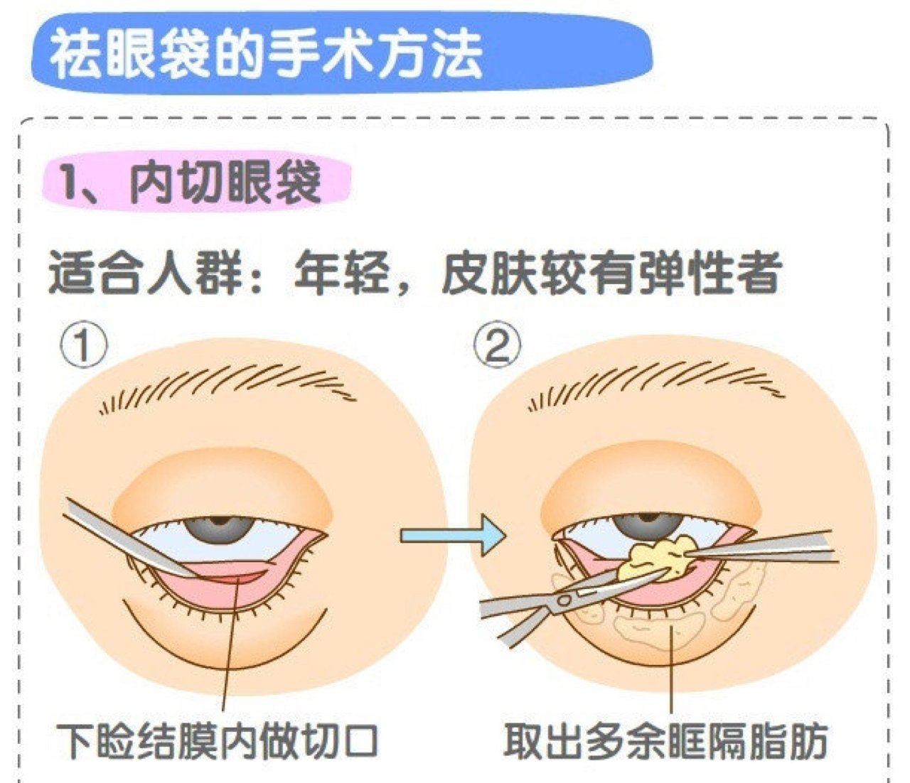 怎样才能消除眼袋？祛眼袋的方法汇总