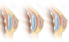 注射玻尿酸隆胸效果怎么
