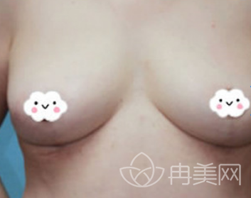 巨乳缩小