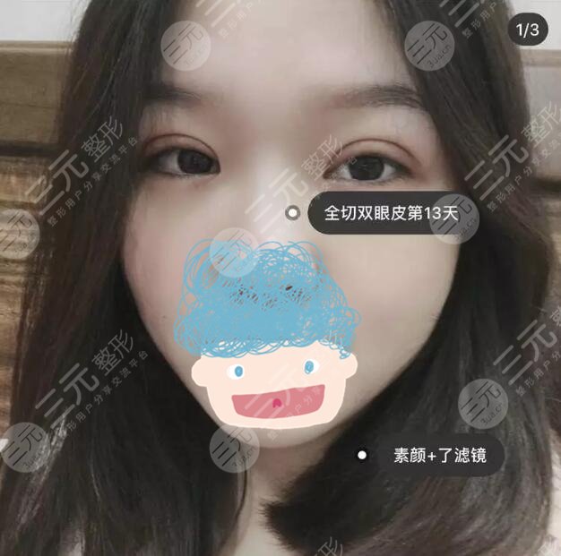 八大处美容整形王淑杰双眼皮案例:术后一周