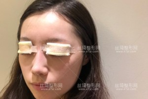 上海九院双眼皮哪个医生做的好？附双眼皮案例图+价格表