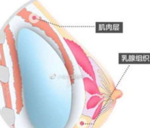 假体隆胸材料有哪些？优缺点分析！看术前攻略