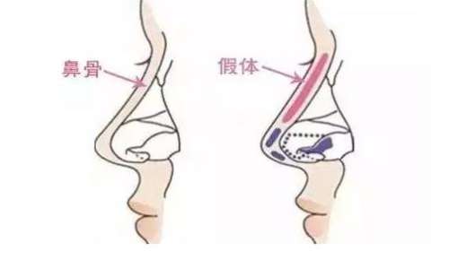 假体隆鼻注意事项有哪些？危害你知道吗？看详情！