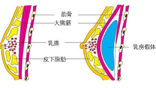 做完假体隆胸手术，学会这个趴床方法恢复快！