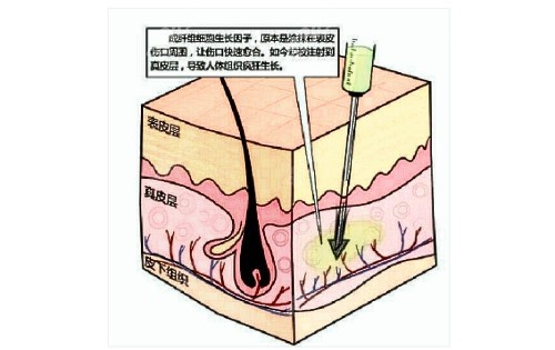 广州荔湾区人民医院生长因子取出手术