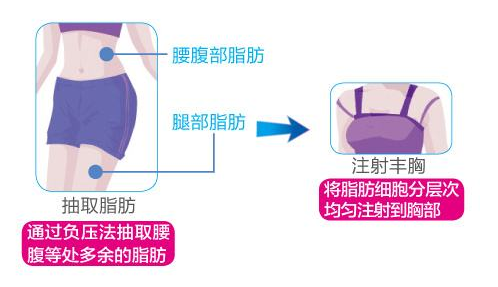 自体脂肪隆胸原理