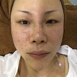 在深圳做了4次激光祛斑的恢复效果,真的干净了