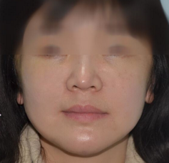 术后图片 术后图片