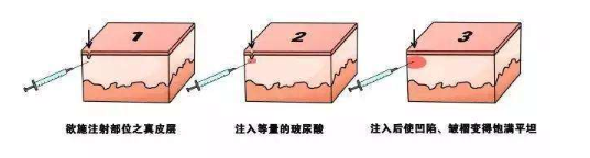 鱼尾纹注射除皱的危害和副作用有哪些？术前要注意什么呢？