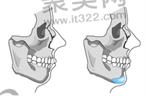 韩国ts和id整形做面部轮廓手术哪个好？各有什么特色优势？