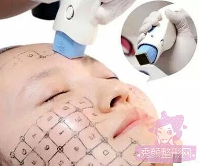 热玛吉,超声提拉,4D埋线提升哪个果好?