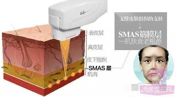 热玛吉,超声提拉,4D埋线提升哪个果好?