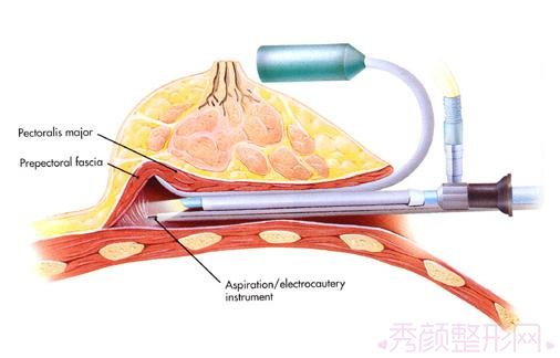 北京八大处栾杰内窥镜隆胸怎么样?有案例吗?