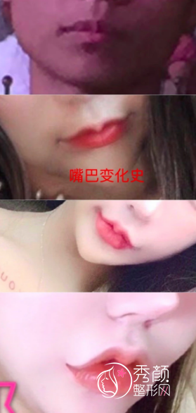 女网红全脸整容,花费400万整容失败却不自知,怒怼黑粉
