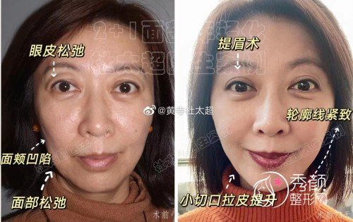 北京黄寺杜太超小切口拉皮提升怎么样,有没有失败案例?