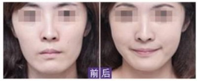 玻尿酸丰卧蚕活动优惠价格，需要多少钱？