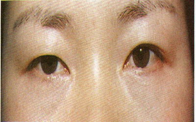 溶脂去眼袋价格费用_大概需要多少钱？