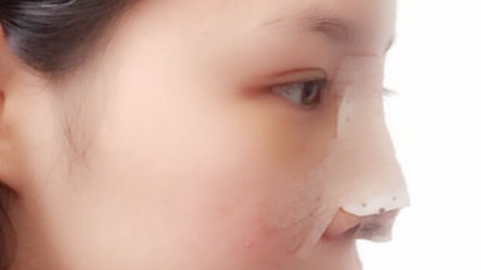 广州紫馨李政祐做鼻子怎么样?手术隆鼻整形案例及价格表