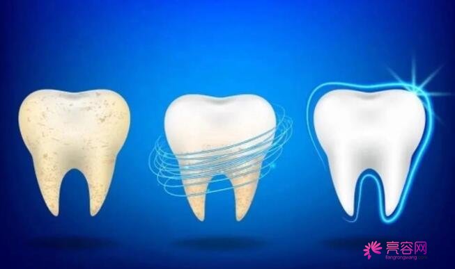 洗牙能让牙齿变白吗？洗牙都有哪些注意事项呢？网友洗牙果图