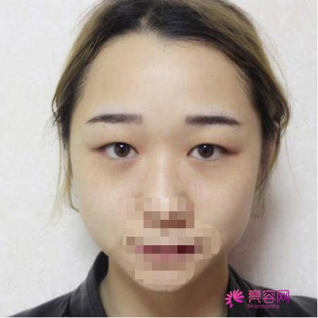 西安晗美整形徐艳眼部手术怎么样？医生信息简介+真人案例体验分享