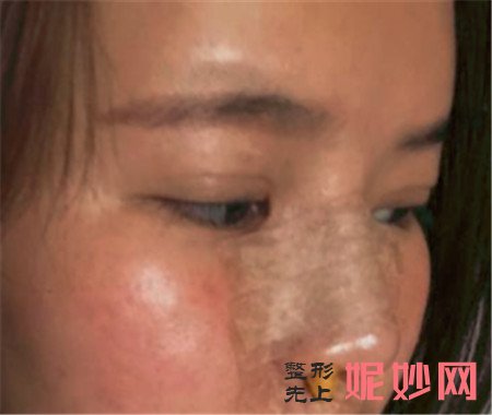 在湘雅二医院整形科找赵柏程做的肋软骨隆鼻，变漂亮后越来越自信！