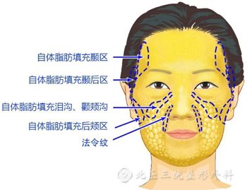 北医三院整形外科面部脂肪填充部位