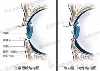 睑内翻