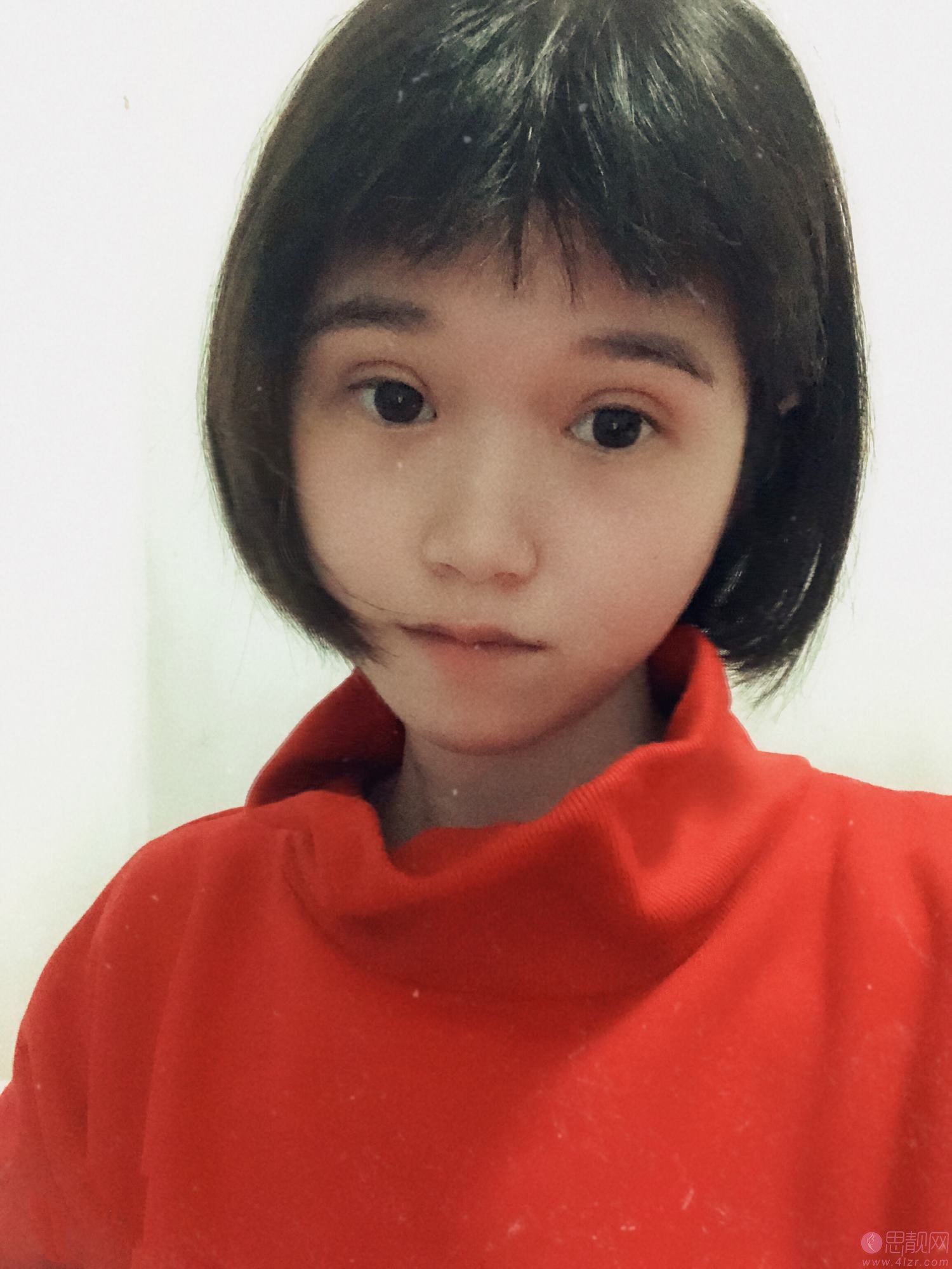 郑州孔宇眼整形怎么样?附双眼皮真人案例分享+2021年价格表发布