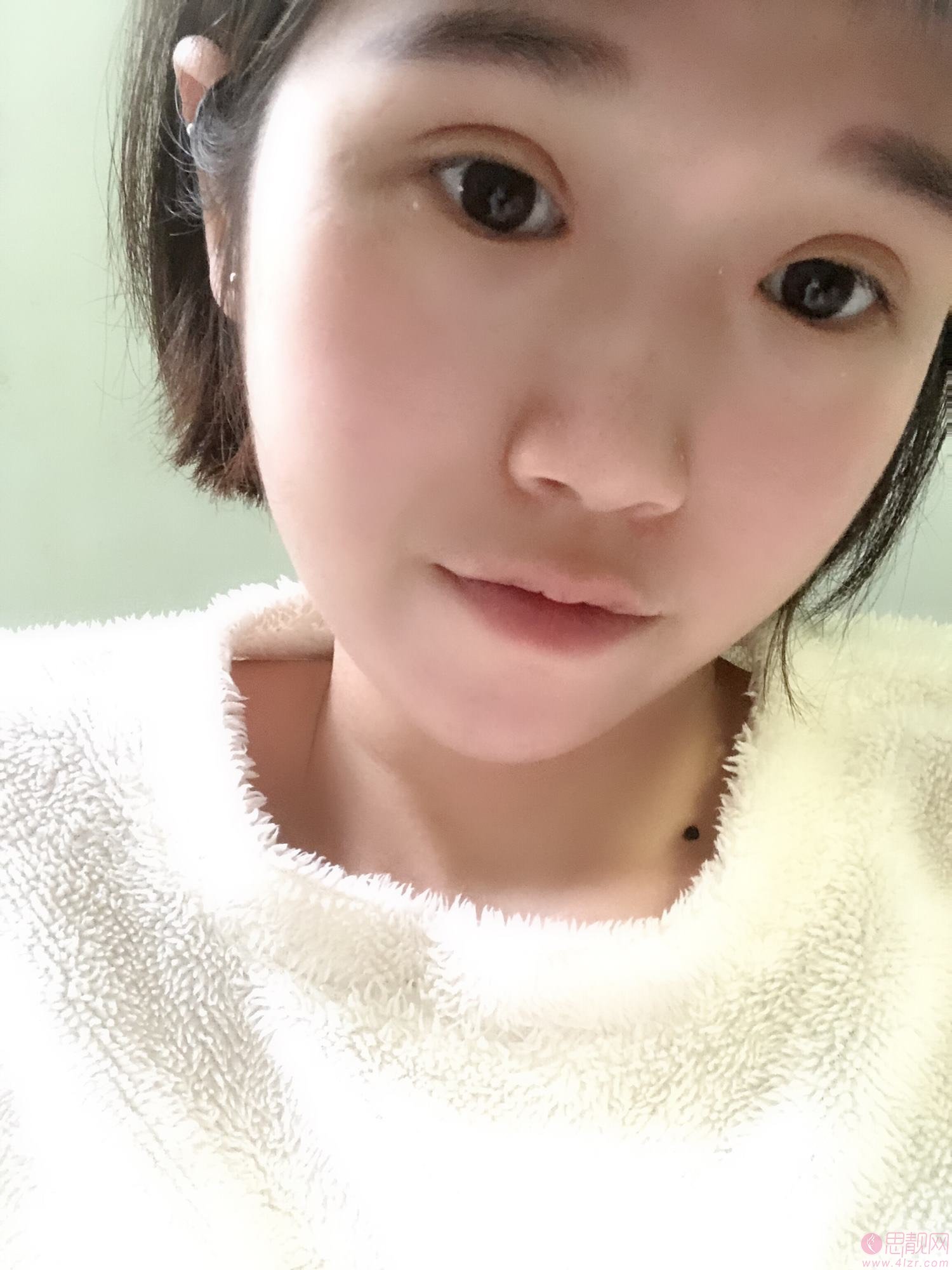 郑州孔宇眼整形怎么样?附双眼皮真人案例分享+2021年价格表发布