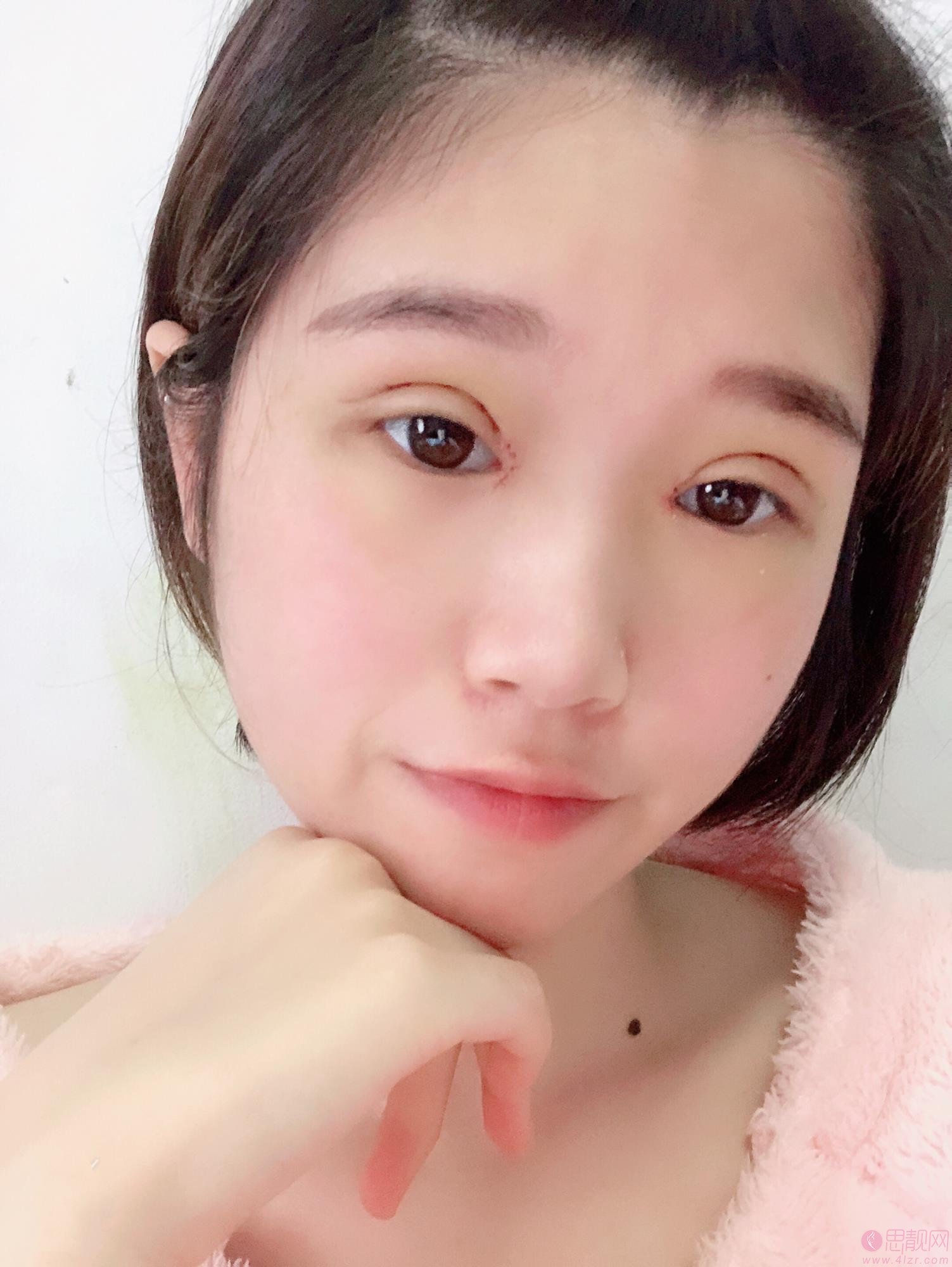 郑州孔宇眼整形怎么样?附双眼皮真人案例分享+2021年价格表发布