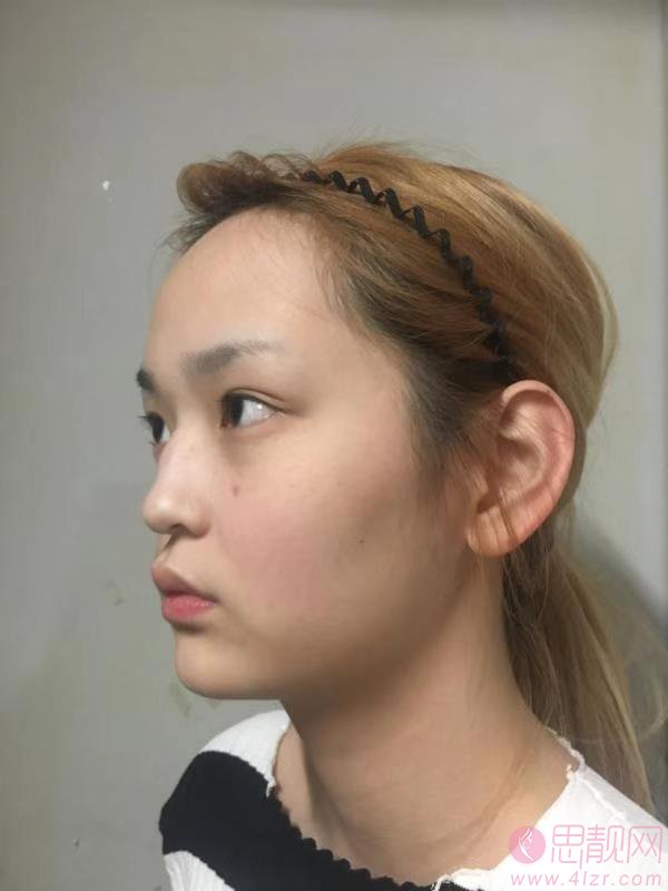 深圳华侨医院美容科籍如恭做鼻子怎么样?附隆鼻真人案例分享+2021年价格表公开