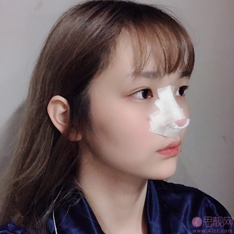 深圳华侨医院美容科籍如恭做鼻子怎么样?附隆鼻真人案例分享+2021年价格表公开