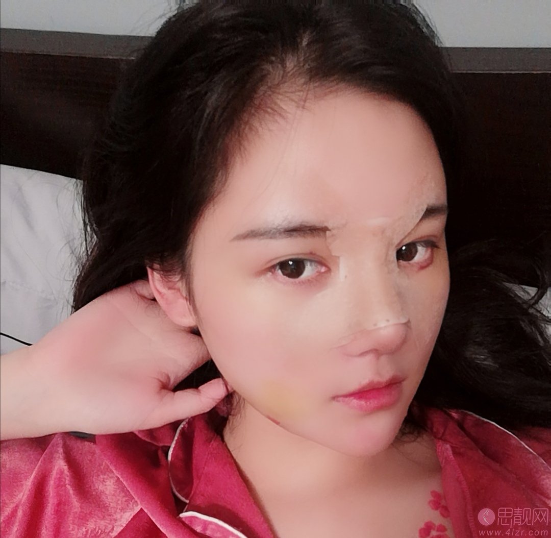 郑州蕾娜斯整形医院正规吗?附隆鼻案例+2021年价格表公开