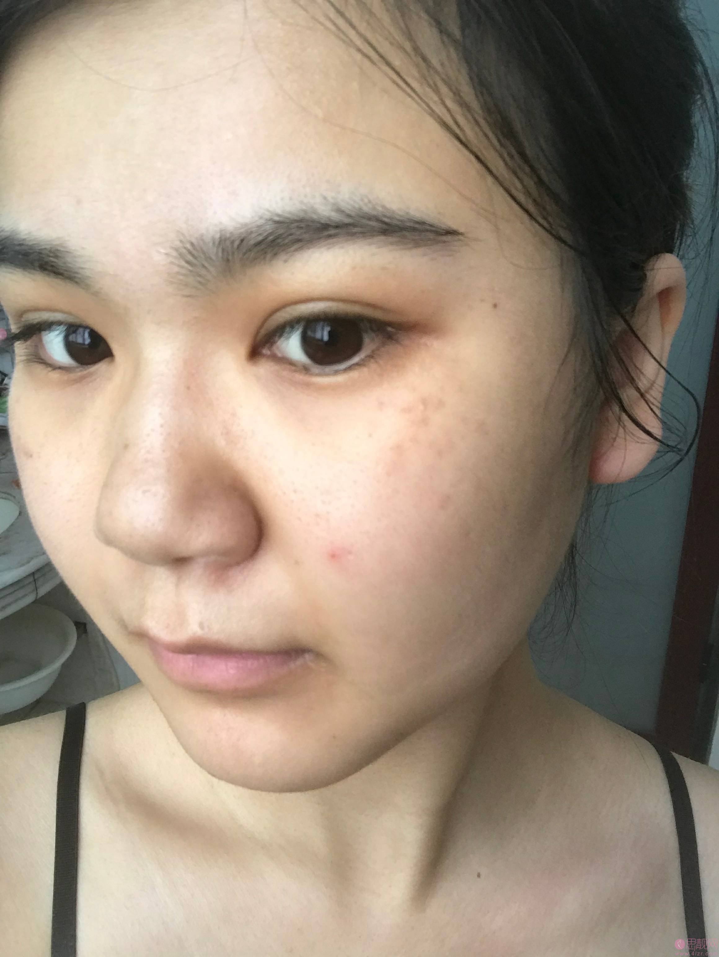 广州曙光美容医院祛斑怎么样?附祛斑前后效果对比及2021项目价格表发布