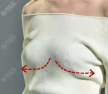 不得不说人工韧带乳房提升术矫正胸下垂效果不错,手术费用多少?