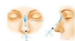 注射隆鼻手术效果可以保持多久