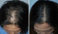 头发稀少的原因及治疗方法