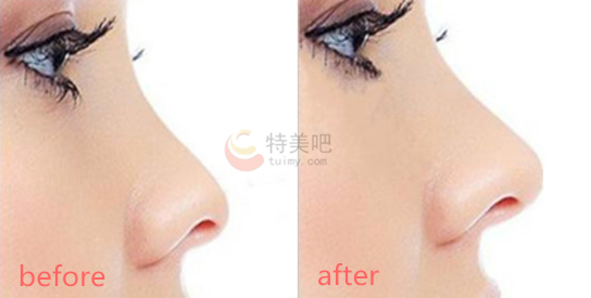 硅胶隆鼻的案例 硅胶隆鼻的案例