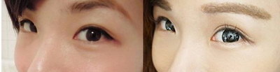 杭州韩式双眼皮需要多少钱_韩式双眼皮切开法价格