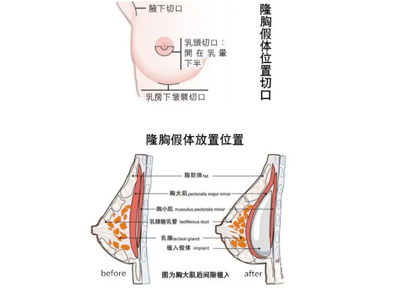 隆胸手术一般多少钱?隆胸很贵吗?