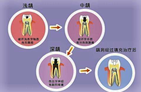 龋坏补牙好还是种牙好