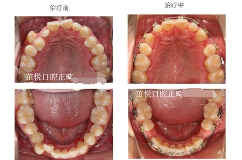 成都茁悦口腔牙齿矫正的案例