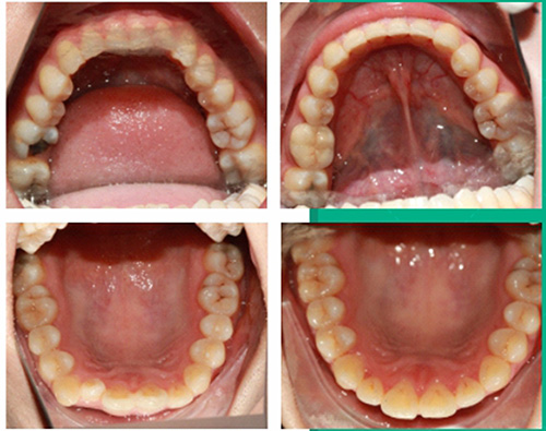深圳登特口腔医院地包天正畸前后对比