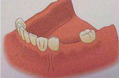 种植牙前示例图