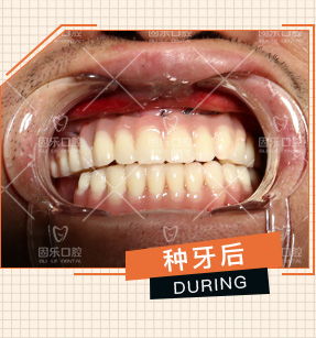 郑州固乐口腔医院全口种植牙案例术后效果