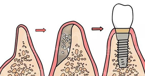 种植牙手术前骨移植过程