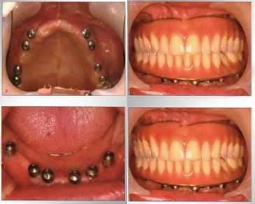 无锡维乐口腔全口种植牙案例
