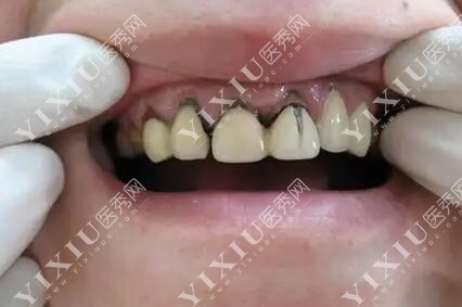 牙冠修复容易出现的后遗症问题