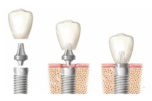 种植牙简易过程示意图